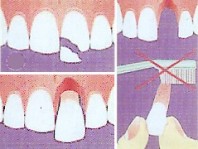 Hinweise zum Verlust eines Zahnes (gezeichnet) Quelle/Autor: Dezernat I - Repräsentation, Zentrale Verwaltungssteuerung, Wirtschaftsförderung Hinweise zum Verlust eines Zahnes (gezeichnet)